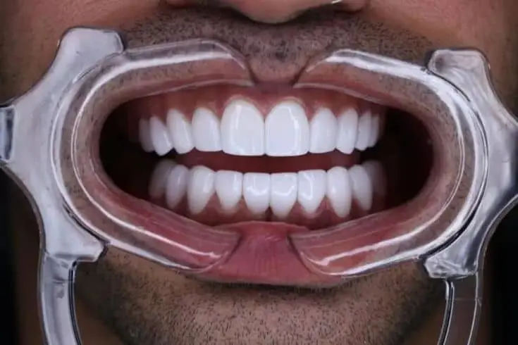 Aesthetic close-up of a person's bright, white teeth with dental retractor for a perfect smile.